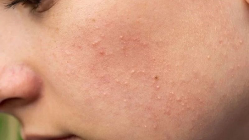 da bị bí tắc có mụn ẩn