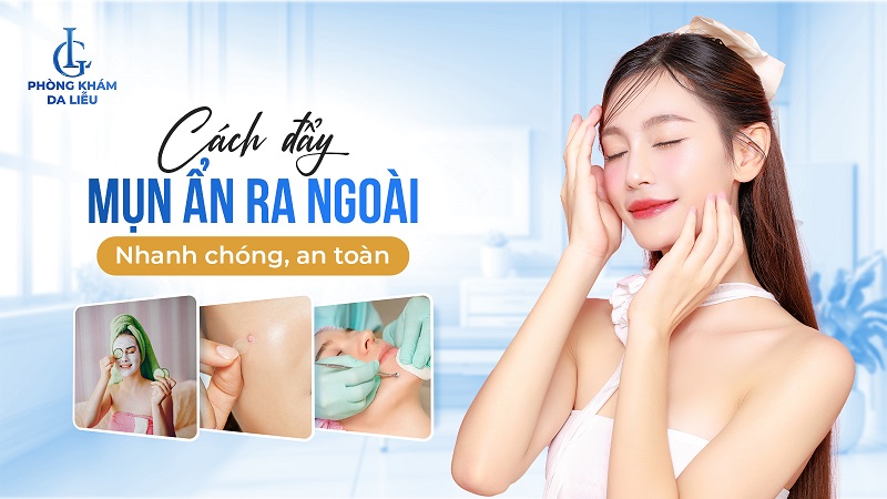 cách đẩy mụn ẩn ra ngoài