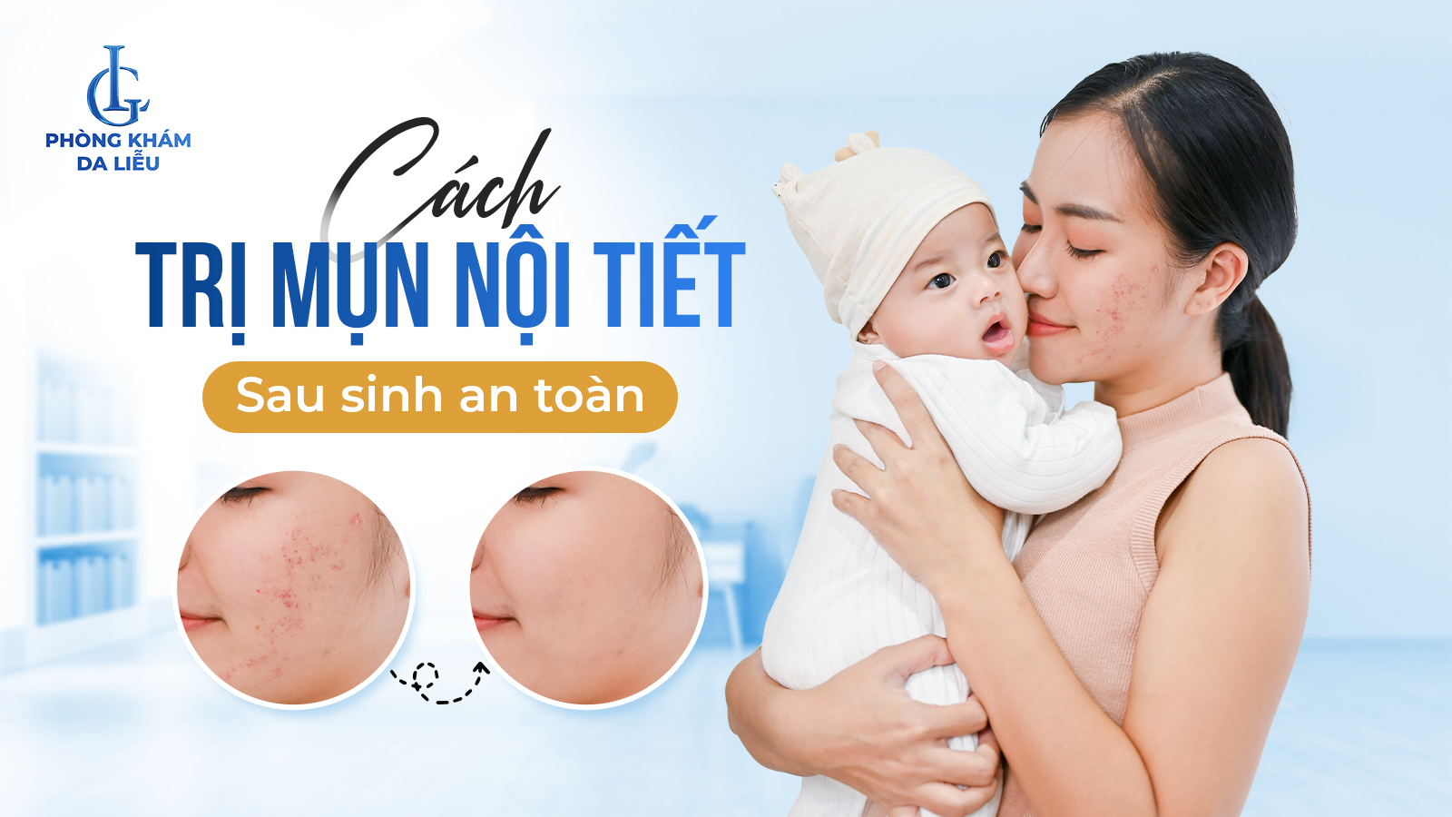 Cách trị mụn nội tiết sau sinh
