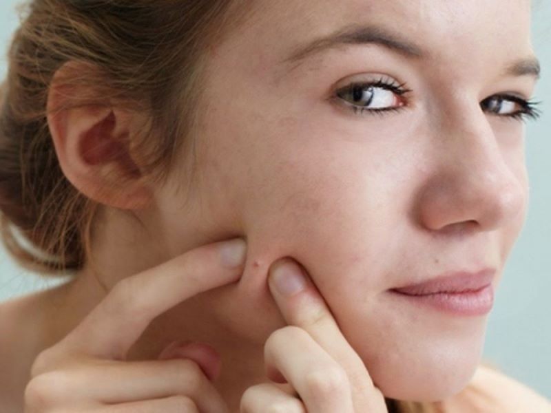Không nặn mụn, sờ tay lên mặt