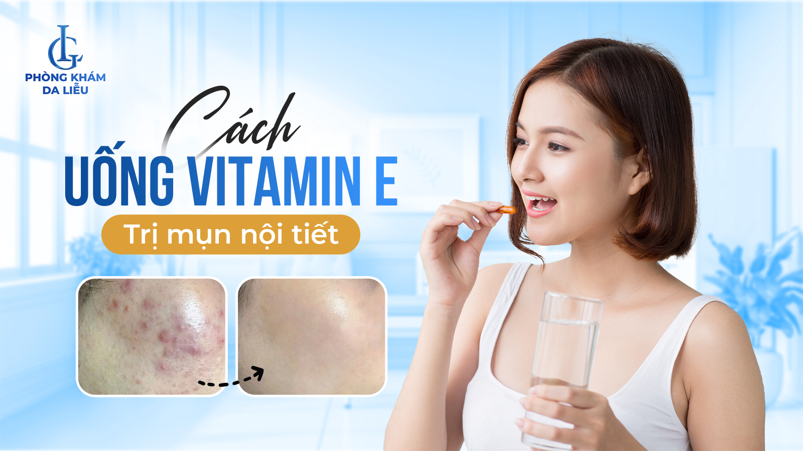 Uống vitamin e trị mụn nội tiết