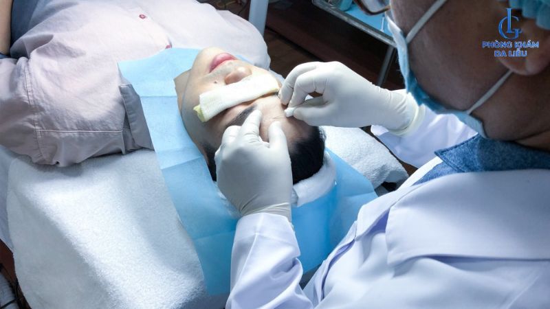 Cắt đáy sẹo lõm, sẹo rỗ