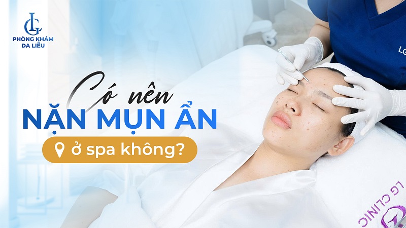 Có nên nặn mụn ẩn ở spa
