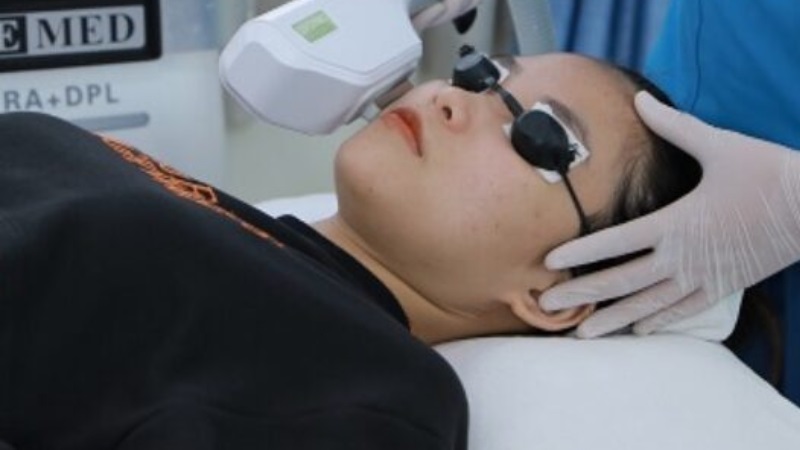 ipl trị mụn viêm