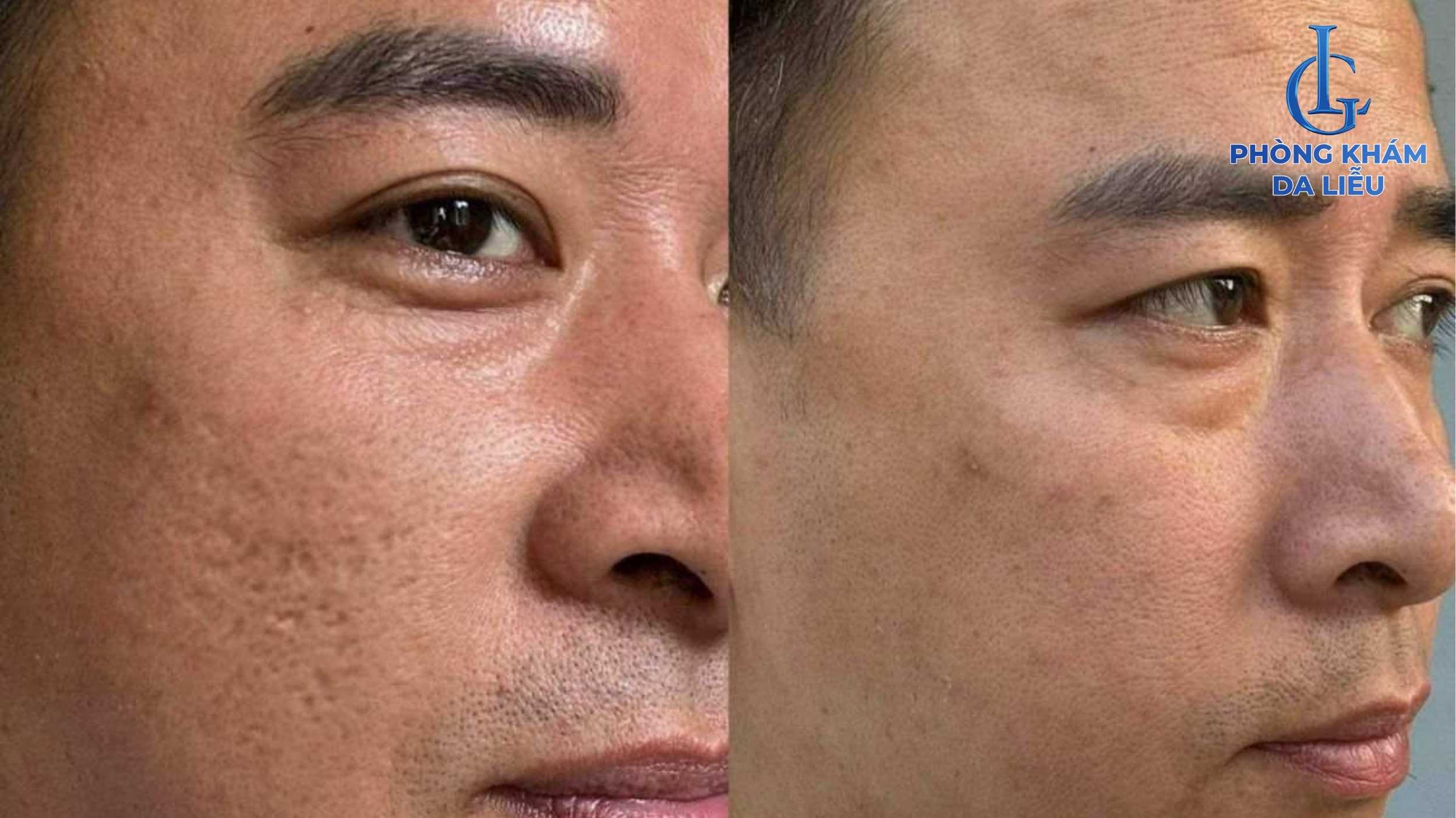 trị sẹo rỗ hiệu quả