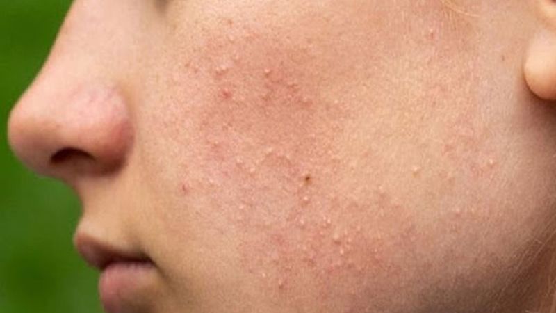 Da sần sùi mụn ẩn