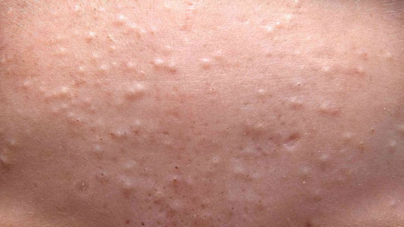 Da sần sùi mụn ẩn li ti