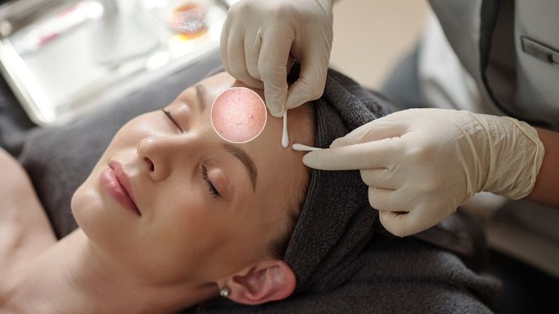 nặn mụn chuẩn y khoa