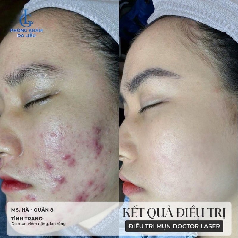 hình trước và sau khi trị mụn