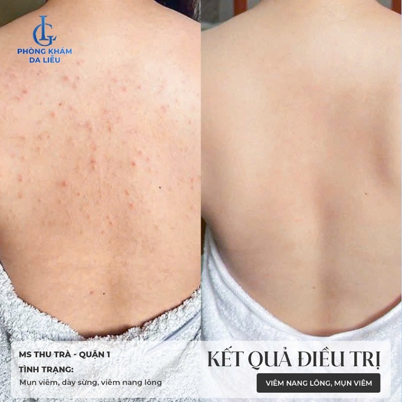 hình trước và sau khi trị mụn