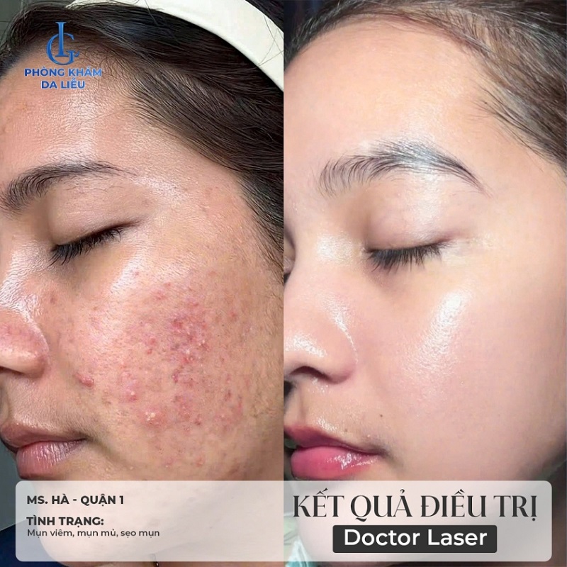 hình trước và sau khi trị mụn