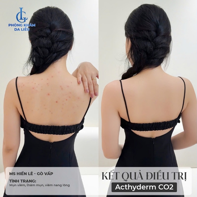 hình trước và sau khi trị mụn