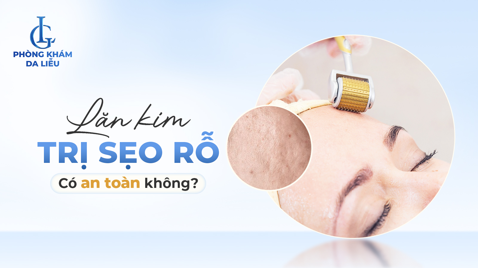 Lăn kim trị sẹo rỗ