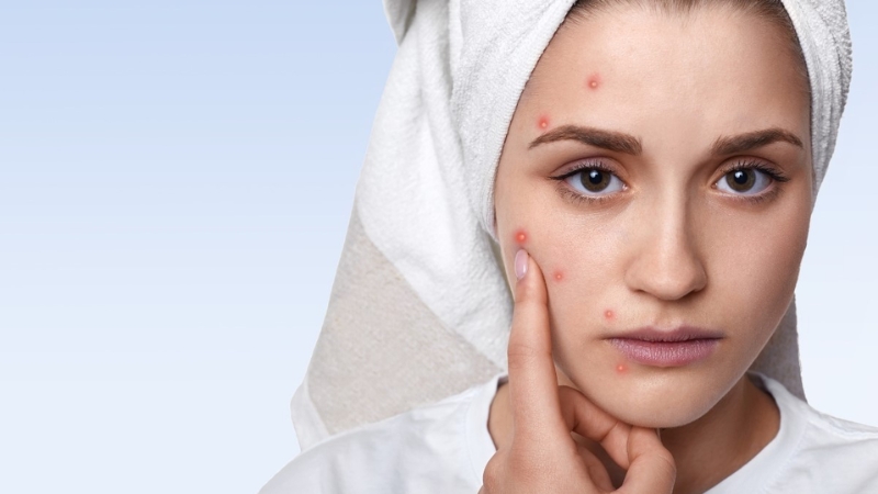 lo lắng về mụn