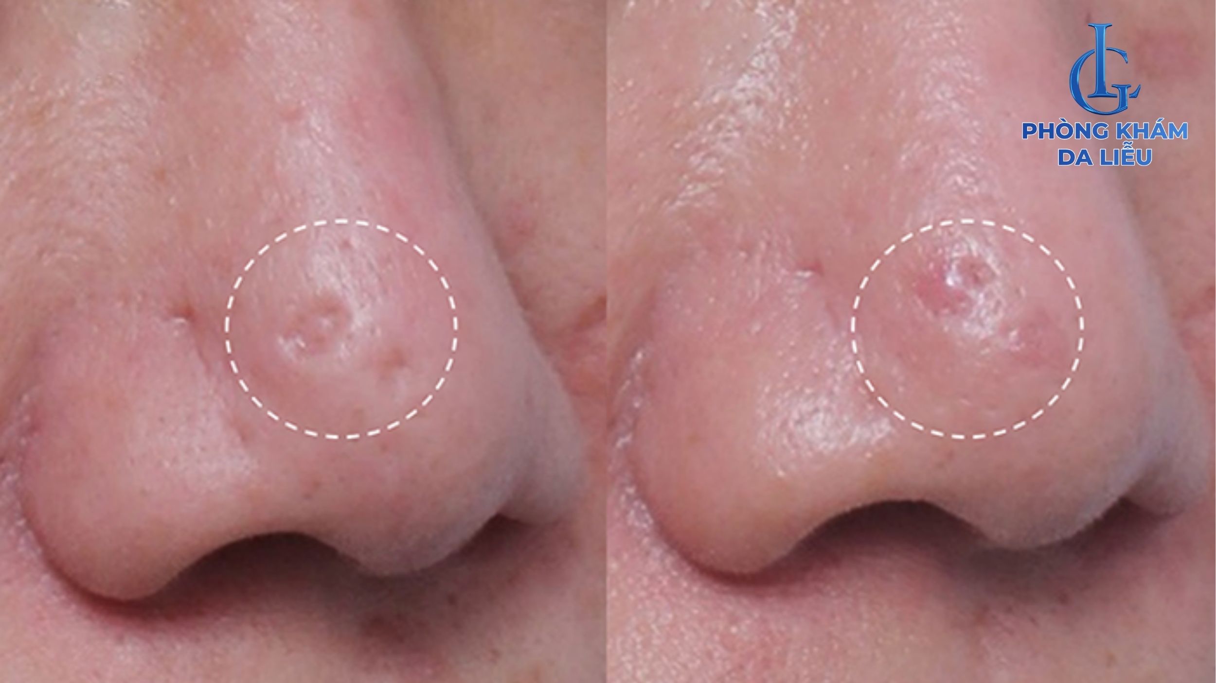 Sẹo lõm ở mũi do mụn