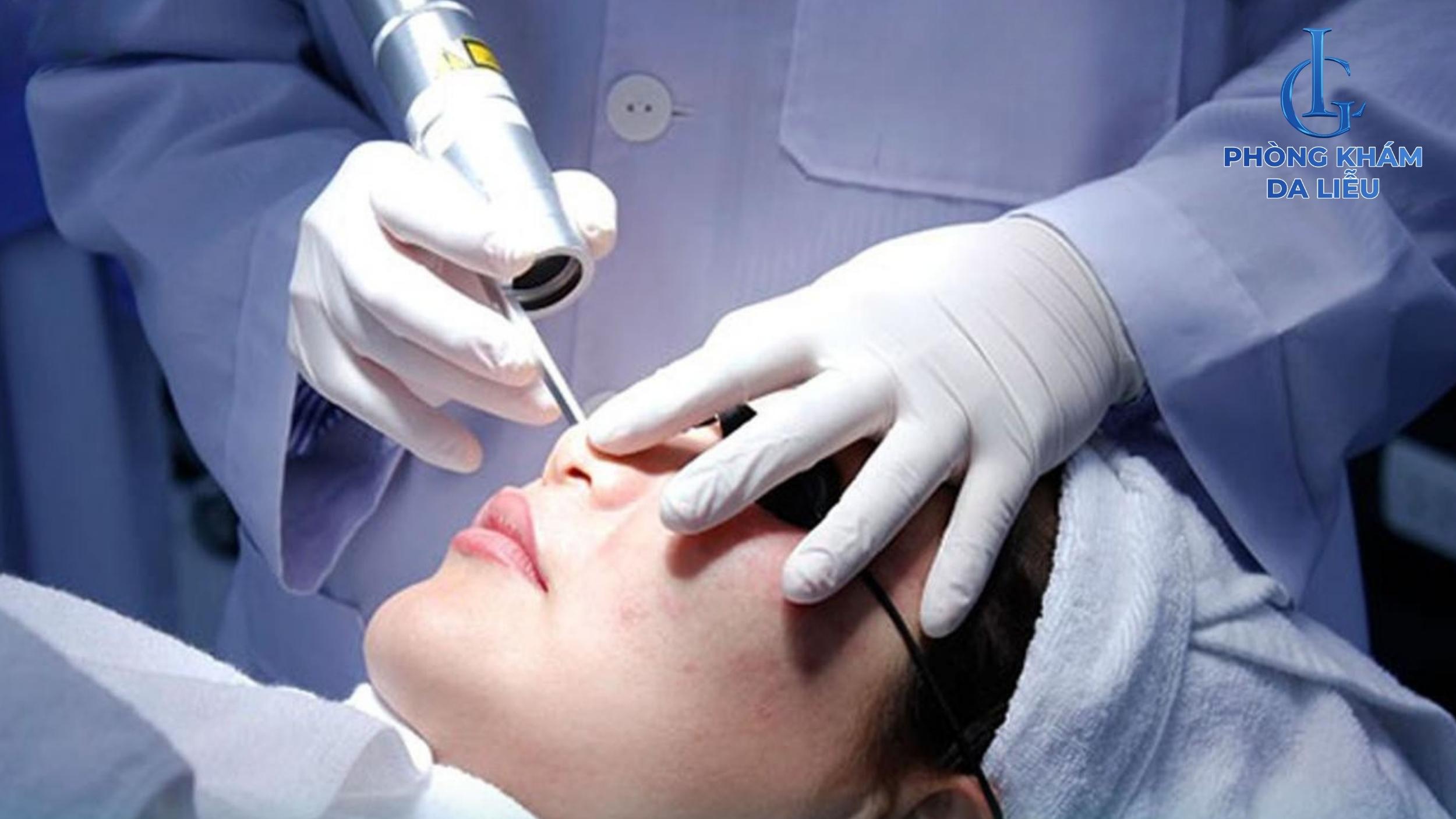 Điều trị sẹo rỗ