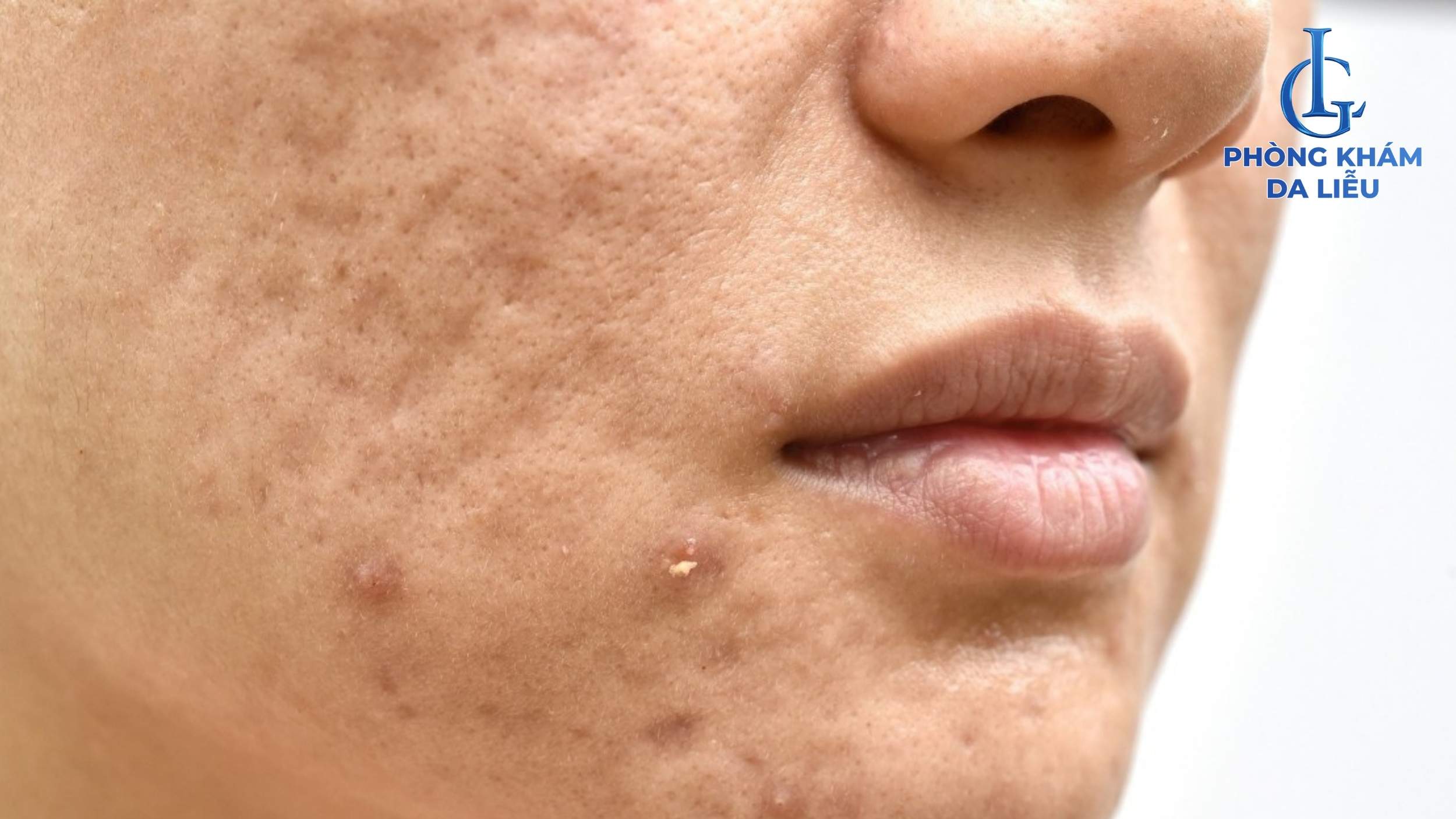 sẹo rỗ lâu năm