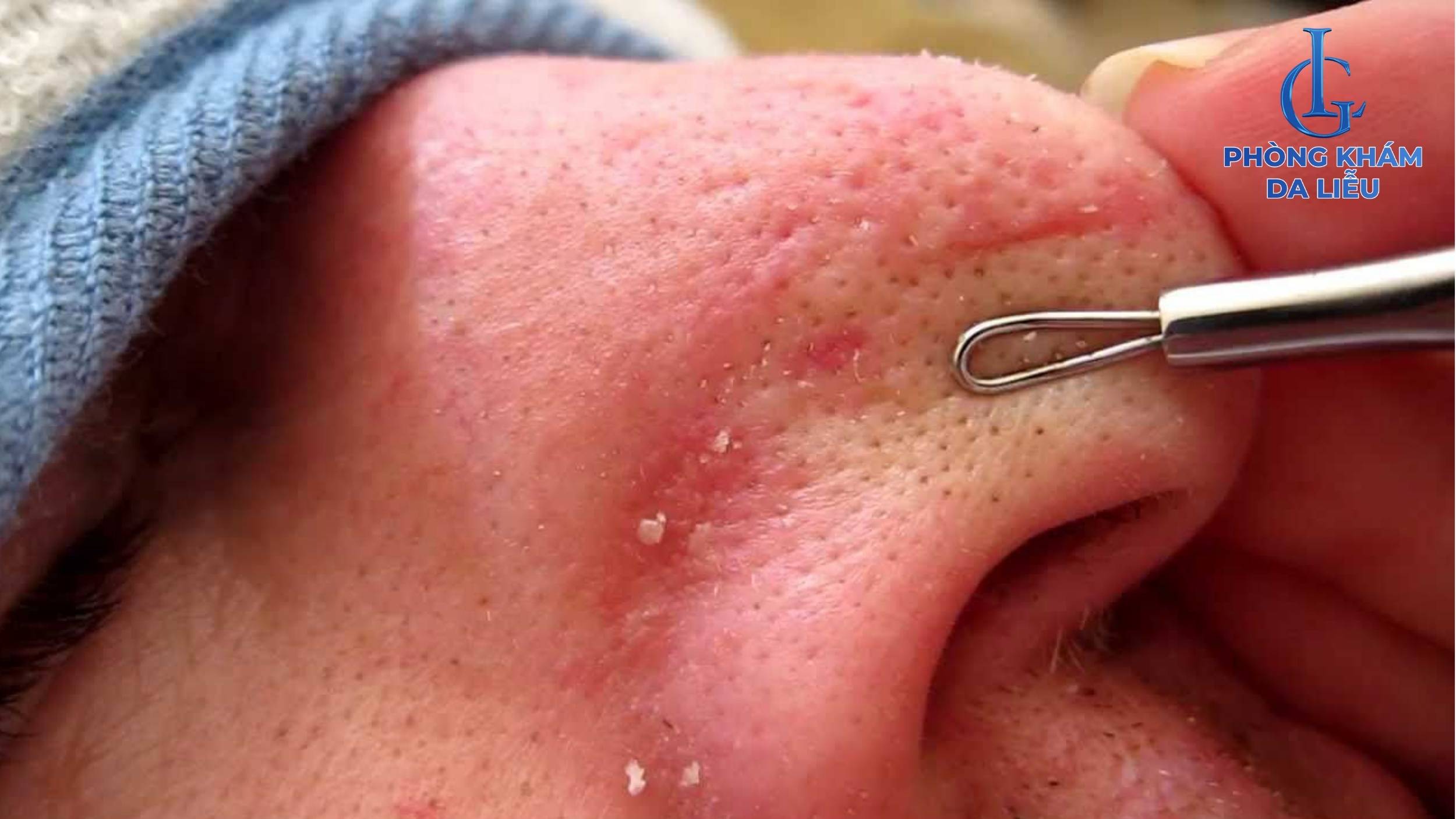 Nặm mụn ở mũi