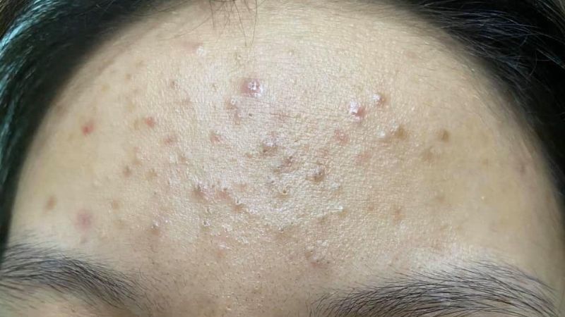 Mụn ẩn ở trán