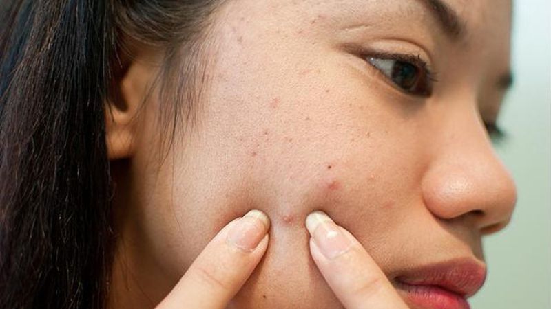 mụn ẩn có nên nặn không​