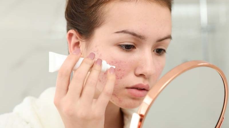 Dùng thuốc trị mụn