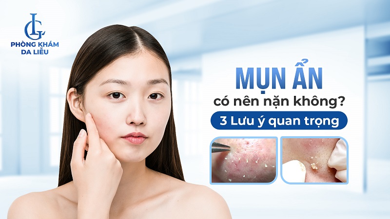mụn ẩn có nên nặn không​