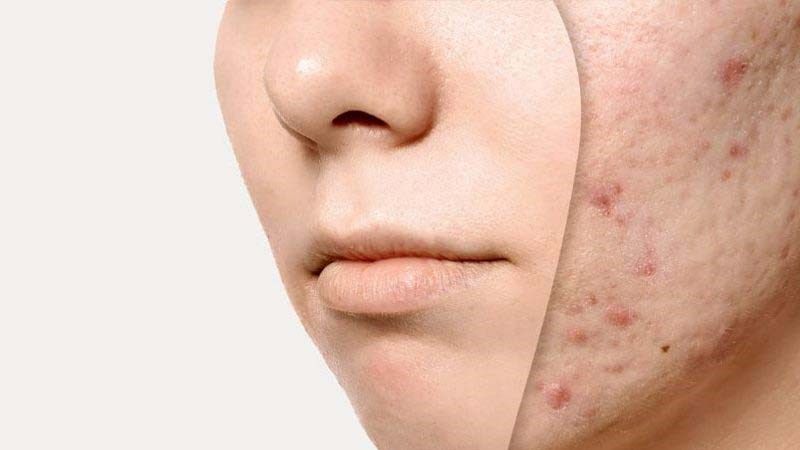 mụn ẩn có tự hết không​