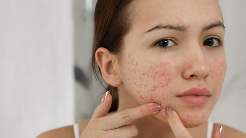 Mụn ẩn bị viêm