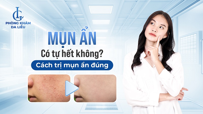 mụn ẩn có tự hết không​