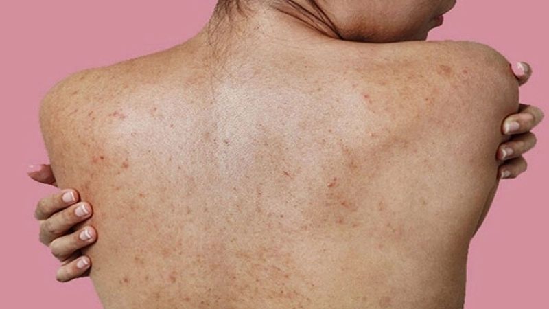 Mụn ẩn ở lưng