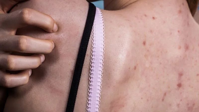 mặc quần áo bí bách ở lưng