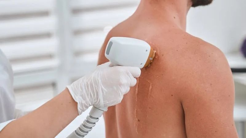 trị mụn lưng bằng laser