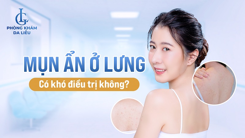 mụn ẩn ở lưng​