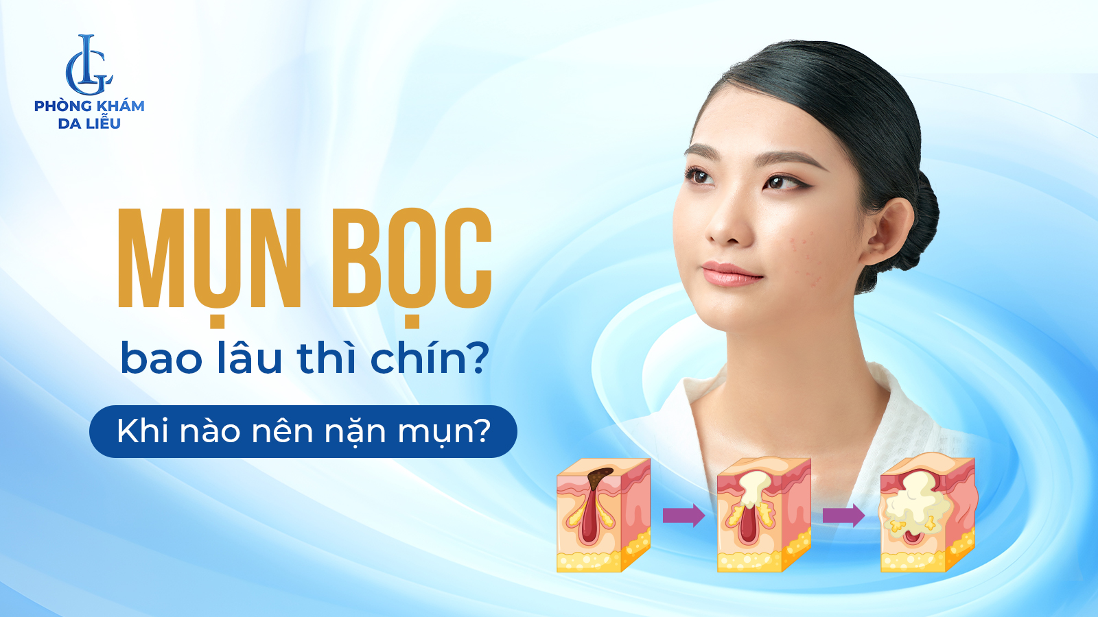 Mụn bọc bao lâu thì chín