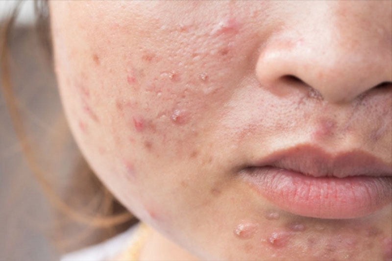 Mụn nội tiết ở nữ