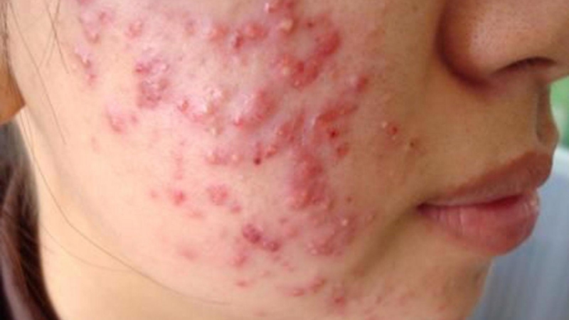 mụn viêm sưng tấy