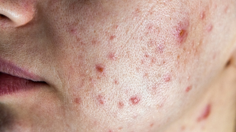 mụn xuất hiện nhiều