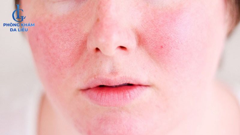 Peel da trị mụn có làm mỏng da không