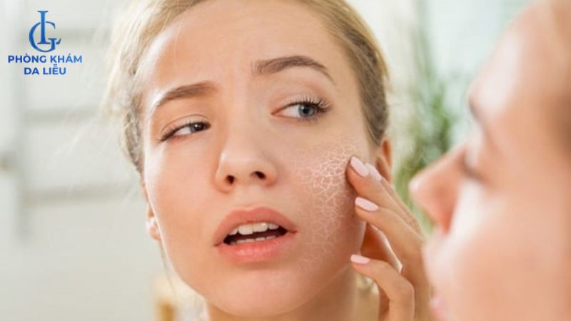 Peel da trị mụn có làm mỏng da không