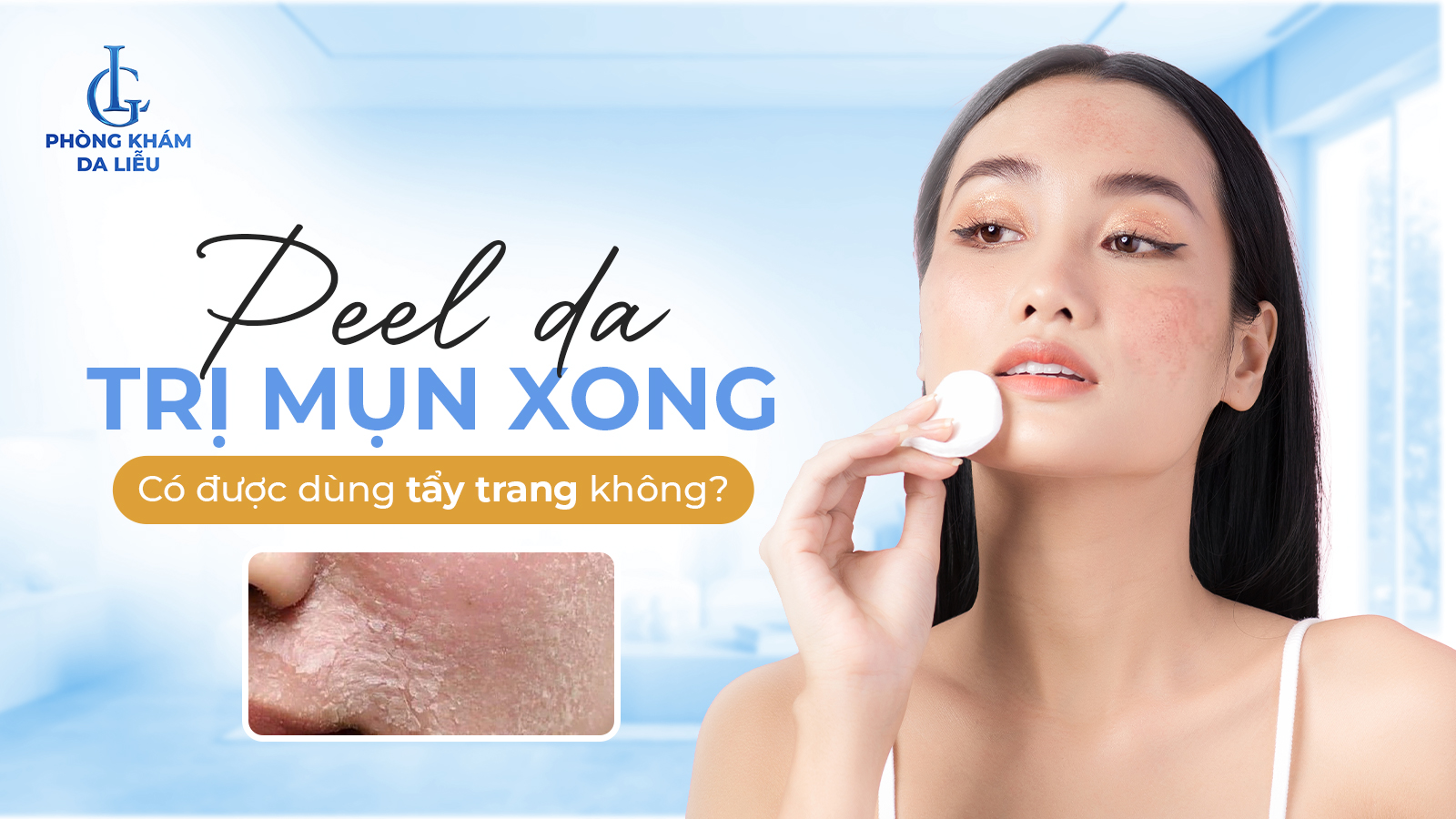 Peel da trị mụn xong có dược dùng tẩy trang không?