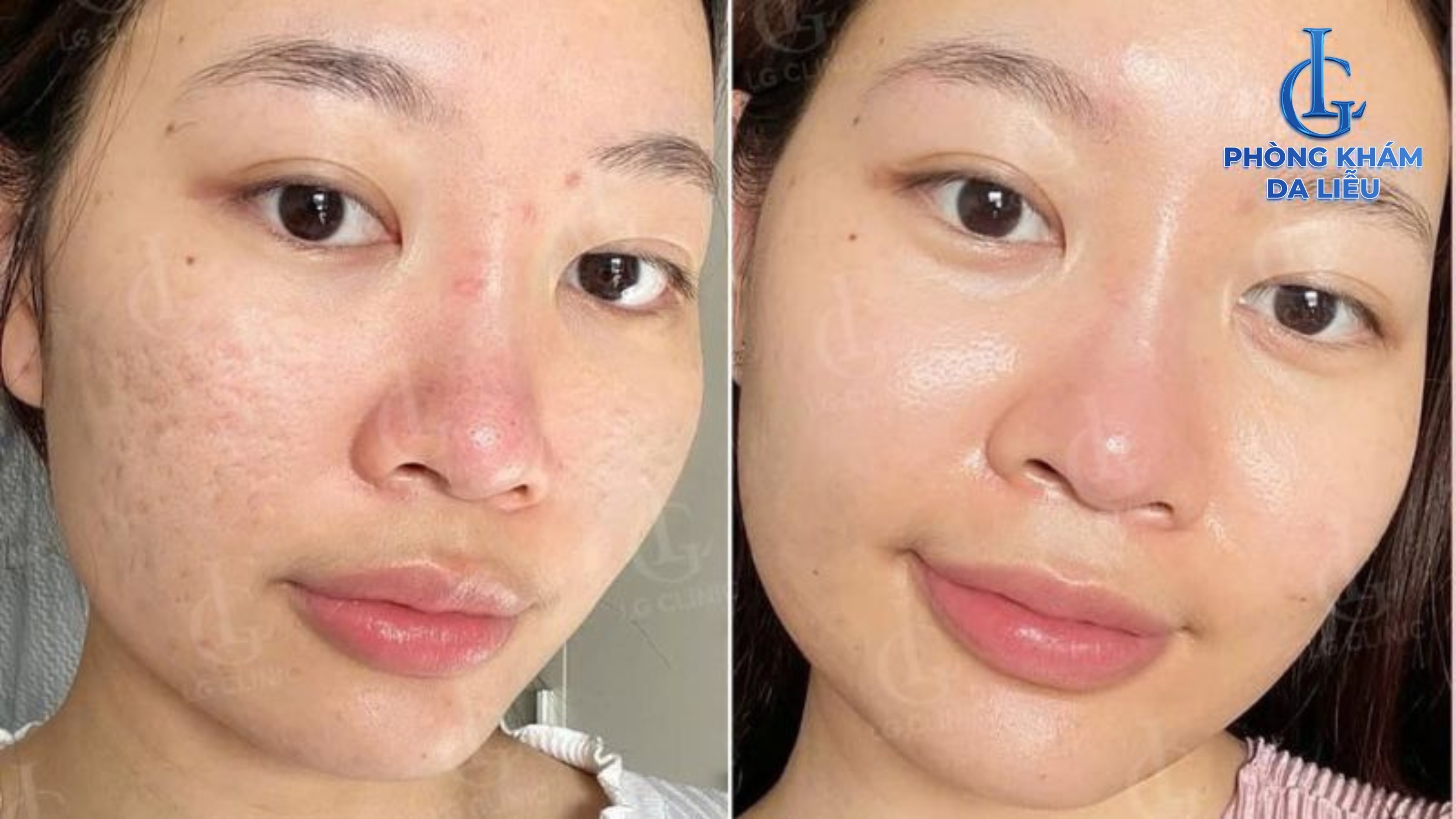 Hiệu quả peel da trị sẹo rỗ