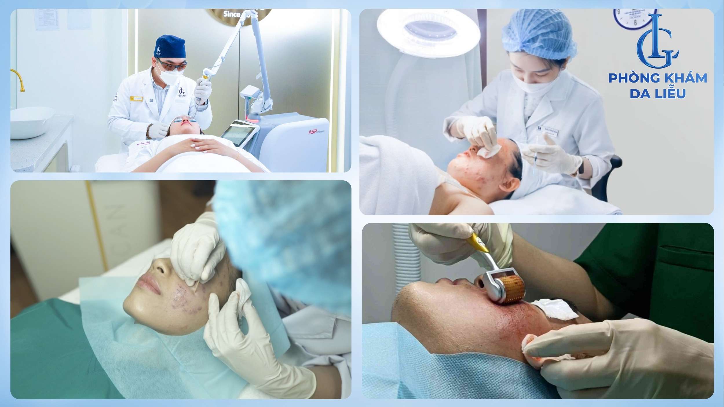 trị sẹo rỗ công nghệ cao