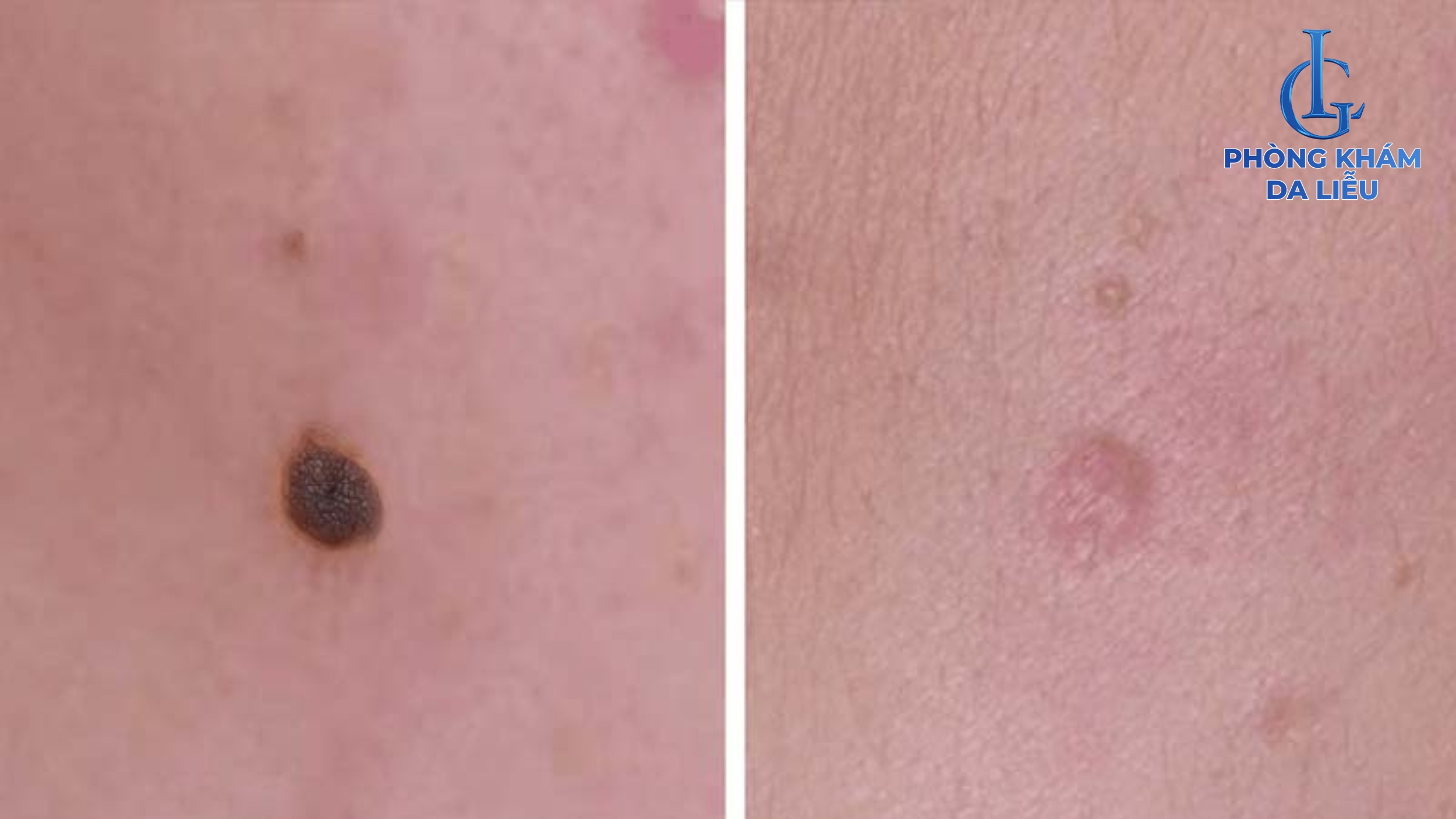 Sẹo lõm sau tẩy nốt ruồi