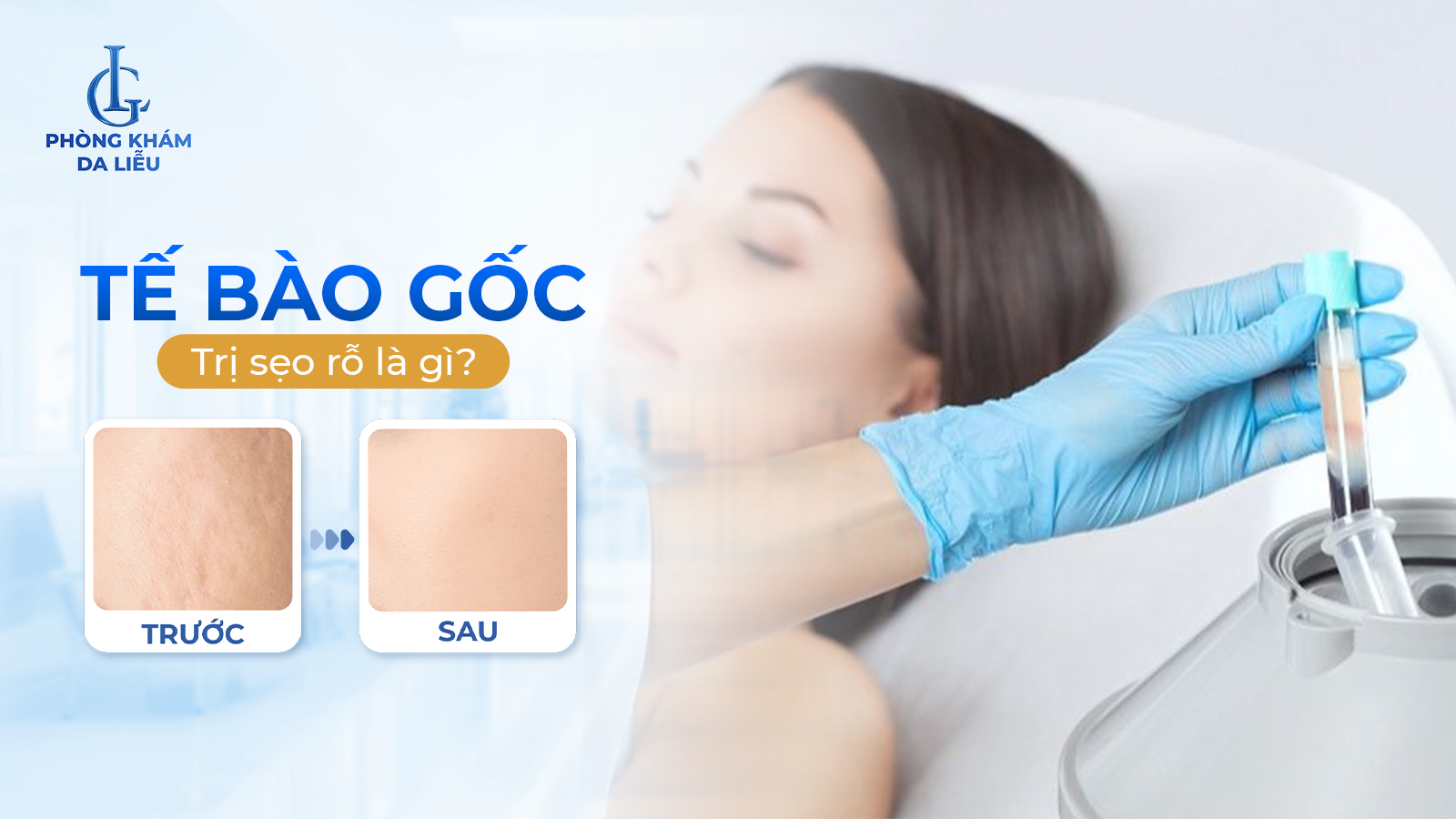 Tế bào gốc trị sẹo rỗ