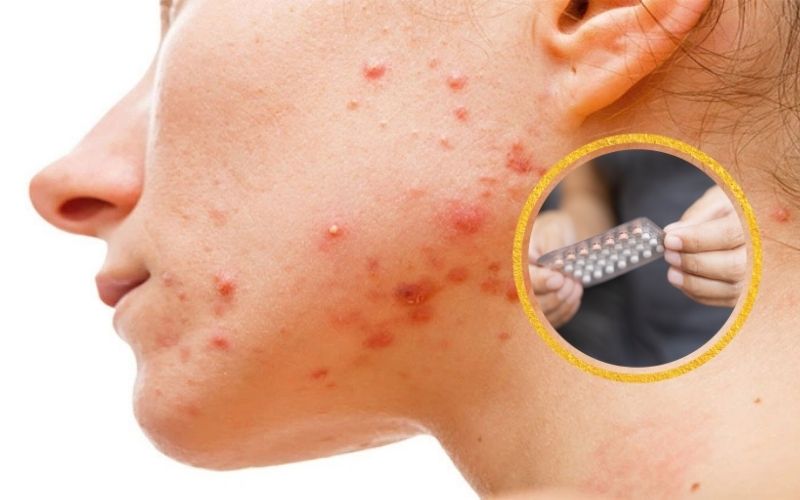 Uống thuốc tránh thai trị mụn nội tiết