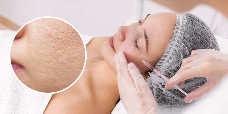 Cơ chế trị sẹo rỗ bằng phương pháp meso