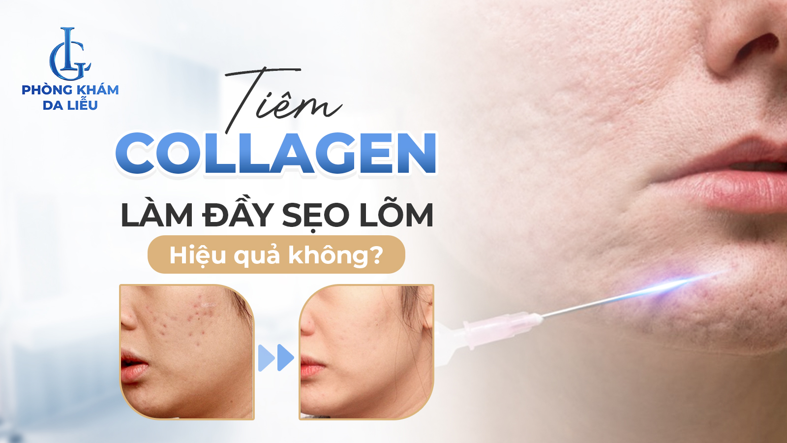 Tiêm collagen làm đầy sẹo lõm