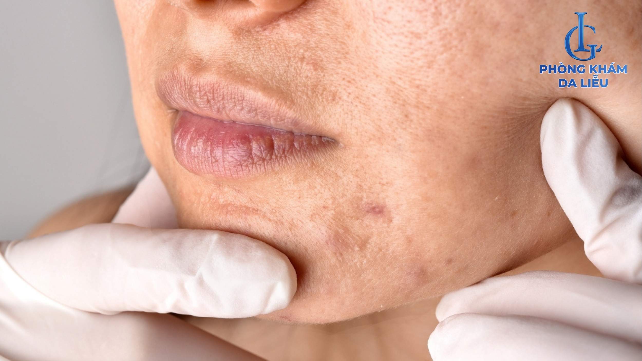 Massage vùng da sẹo