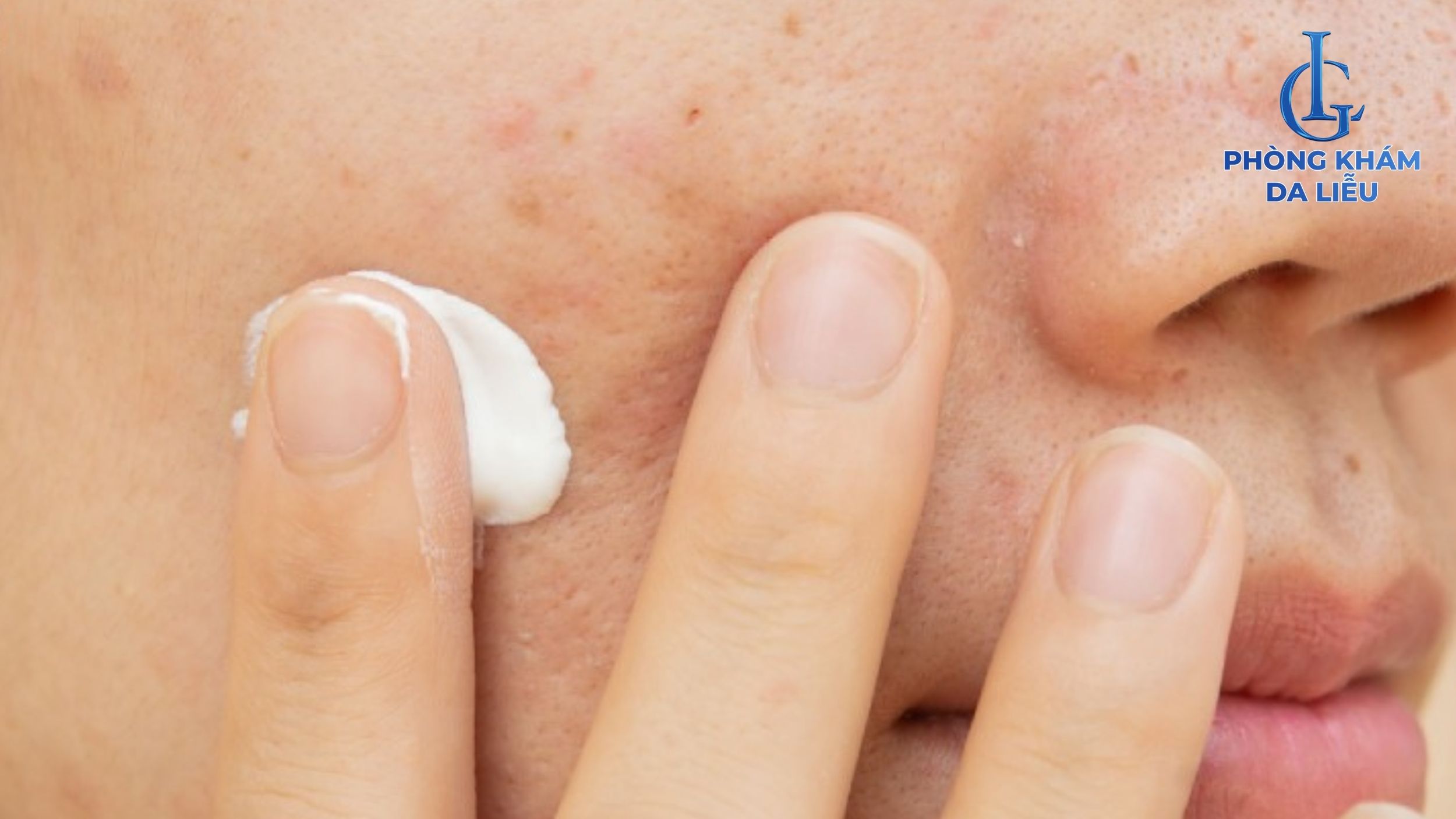 bôi thuốc trị sẹo