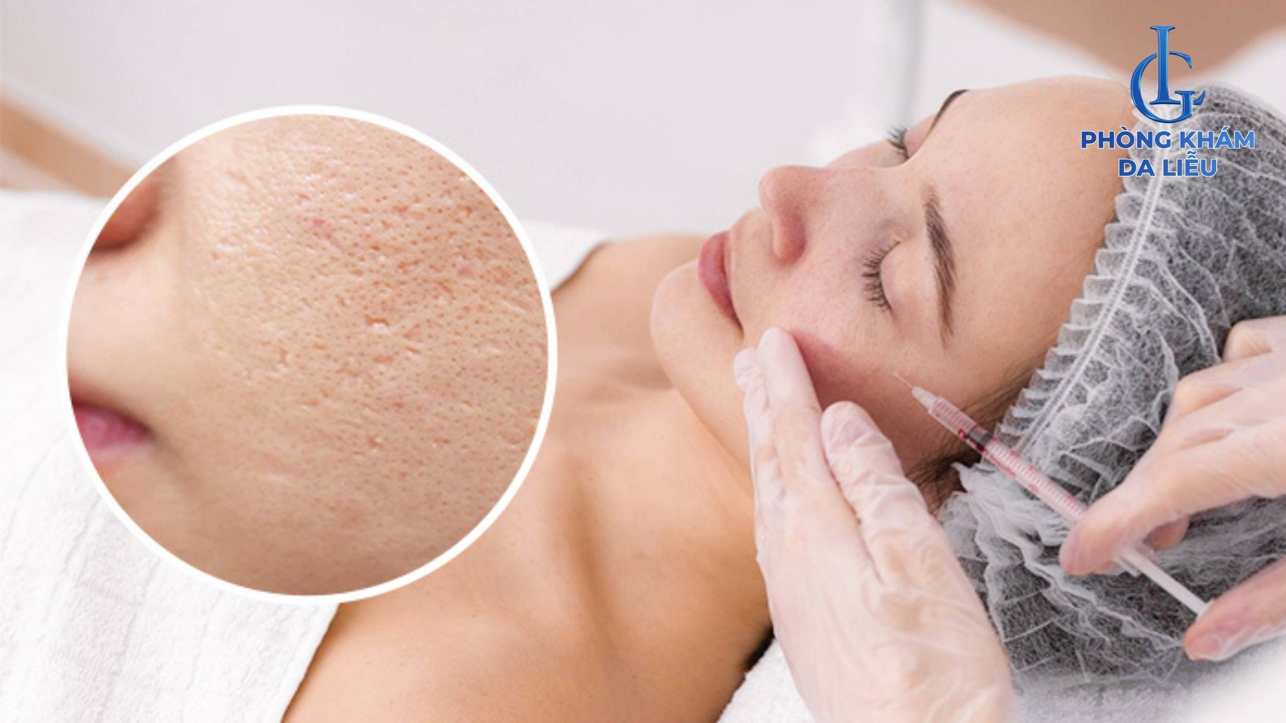 Meso trị sẹo lõm